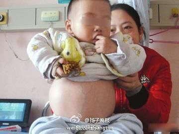 1歲男童摔跤后意外發(fā)現(xiàn)腦內(nèi)腫瘤