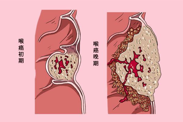 喉嚨腫痛引發(fā)呼吸困難的急救措施